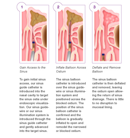 step by step: sinuplasty in action